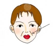 面部凹陷用什么填充好？根据不同情况选择适合自己的材料美丽脸部！
