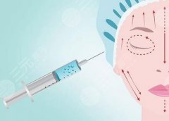 玻尿酸除皱多少钱?安全性、效果知识分享,选择适合自己的除皱方式! 玻尿酸除皱多少钱?安全性、效果知识分享,选择适合自己的除皱方式!