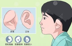 小耳畸形几岁做手术好？耳整形科普&价格分享！