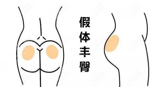 假体丰臀要多少钱？手术原理及价格分享，蜜桃美腿指南！