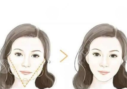 面部轮廓固定需要多少钱？