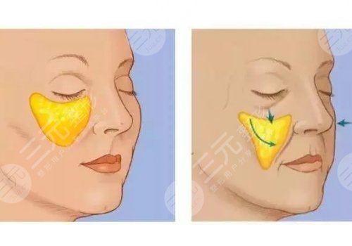 苹果肌复位是什么手术?