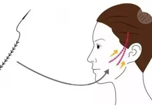 线雕适合多大年龄？