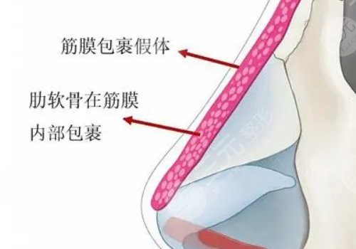 筋膜填充会被吸收吗？