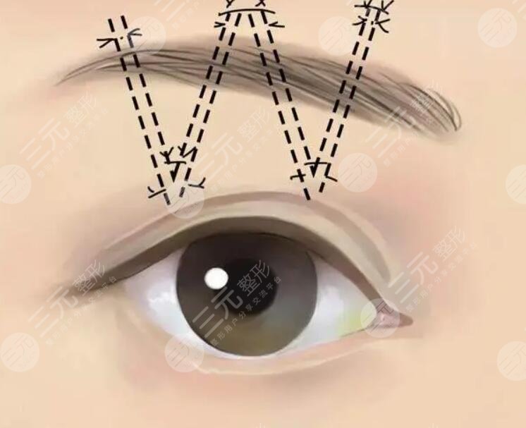 上海九院双眼皮手术注意事项