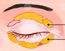 激光去眼袋的价格？激光去眼袋的危险性和三个方面的术后护理科普！