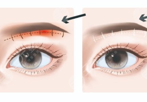 提眉术多久可以恢复自然？