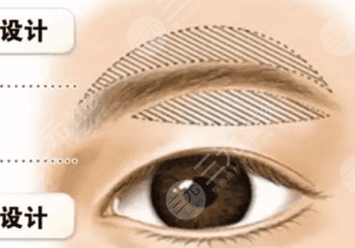 提眉术多久可以恢复自然？
