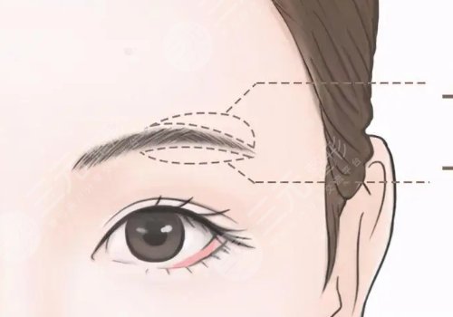 提眉术多久可以恢复自然？