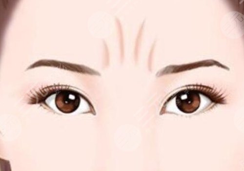 医美去川字纹有效的方法玻尿酸填充怎么样？