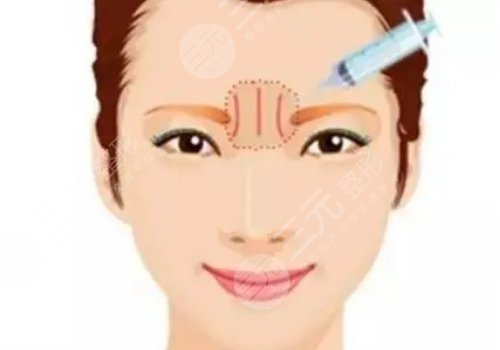 医美去川字纹有效的方法玻尿酸填充怎么样？