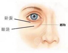 卧蚕与眼袋的区别有哪些？激光去眼袋知识和日常预防方法分享来啦！