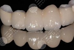 烤瓷牙修复能美白牙齿吗？烤瓷牙与全瓷牙区别、烤瓷牙作用、价格~