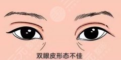 双眼皮修复价格多少？双眼皮修复恢复期多久、风险大小可了解！