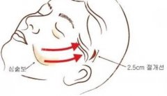 拉皮手术价格一览表！拉皮手术维持时间、风险和恢复自然的时间~