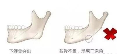 上海九院下颌角手术注意事项