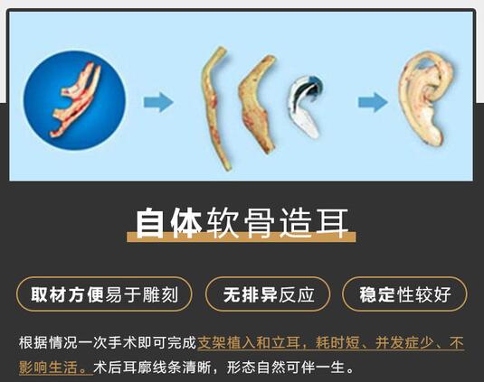 外耳再造的较佳支架材料是什么？对比分析、手术原理科普！