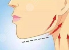 面部小拉皮多久消肿？可以维持多久？注意术后护理帮助更好恢复！