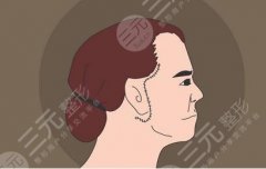 拉皮后需要多久的恢复期？拉皮手术的价格、注意事项、优势科普！