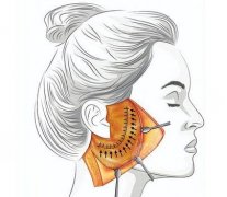 面部拉皮手术多久恢复自然？注意护理细节！拉皮简介、维持时间~