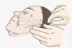 拉皮能维持多久？拉皮手术是什么、三个方面注意事项了解一下！