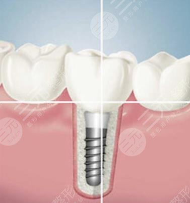 种植牙