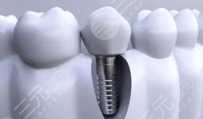 种植牙