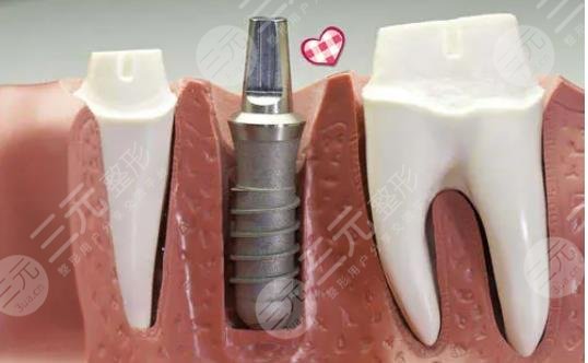 种植牙