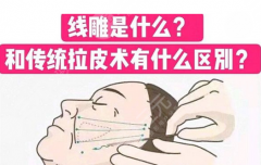 做拉皮手术好还是做线雕好?拉皮与线雕的原理、区别、注意事项一览 做拉皮手术好还是做线雕好?拉皮与线雕的原理、区别、注意事项一览