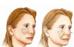 脸做拉皮手术会不会有后遗症？减少担心提前了解原理和注意事项吧！