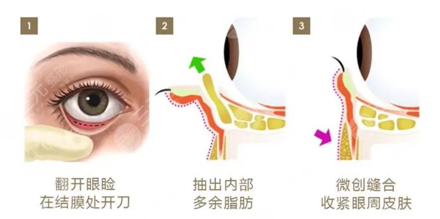 外切眼袋加眶隔释放加填充泪沟