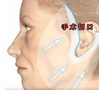 小拉皮手术切口在哪里?小拉皮手术的原理和手术后注意事项~ 小拉皮手术切口在哪里?小拉皮手术的原理和手术后注意事项~