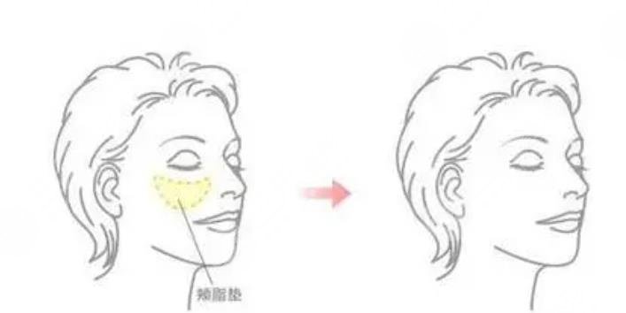 去颊脂垫