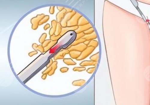 北京清木医疗美容诊所吸脂怎么样？