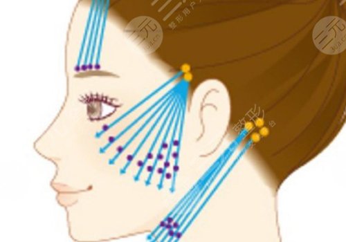 做完线雕多久可以恢复？