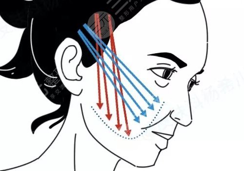 做完线雕多久可以恢复？