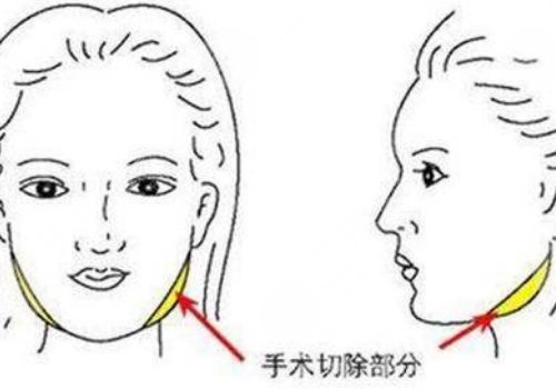 轮廓手术从哪里开刀？