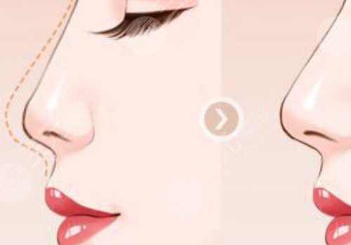 打造幼态脸需要做多少项目？