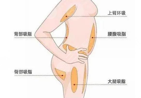 抽脂手术大概要多少钱