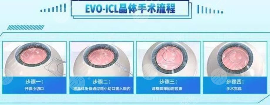 晶体植入手术的利与弊