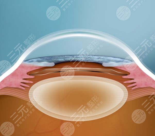 晶体植入手术的利与弊