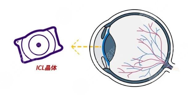 晶体植入手术的利与弊