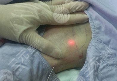 医疗方法去掉狐臭|医美项目