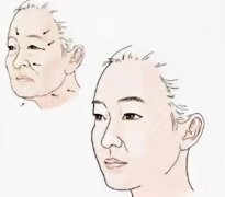 小切口拉皮手术费多少钱?一起了解小拉皮如何选择医院、护理事项~ 小切口拉皮手术费多少钱?一起了解小拉皮如何选择医院、护理事项~