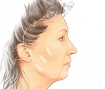面部拉皮手术是怎么做的？拉皮手术选择医院和术后注意事项很重要！