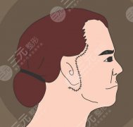 拉皮手术多少钱?注意什么呢?拉皮手术医院选择技巧~ 拉皮手术多少钱?注意什么呢?拉皮手术医院选择技巧~