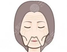 做拉皮老了以后会有什么变化?做拉皮手术适宜人群和注意事项了解一下 做拉皮老了以后会有什么变化?做拉皮手术适宜人群和注意事项了解一下