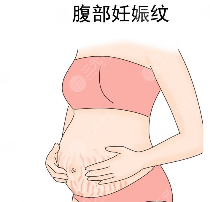妊娠纹怎么消除