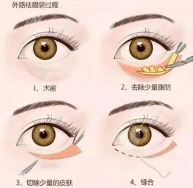 外切眼袋手术疤痕多久能看不见
