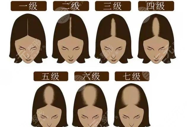 脱发1-7级程度